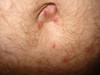 Лимфоплазия кожи. Клинические фото #1565