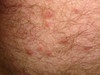 Лимфоплазия кожи. Клинические фото #1566