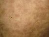 Пурпура тромбоцитопатическая. Клинические фото #1599