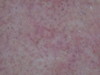 Пурпура тромбоцитопатическая. Дерматоскопия #1604