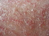 Астеатотическая экзема, eczema craquele. №1612