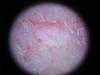 Астеатотическая экзема, eczema craquele. №1613