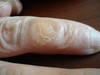 Брюнауэра-Франческетти кератодермия. Клинические фото #1662