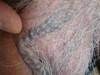 Варикозная болезнь: варикозное расширение вен кожи мошонки, голеней и «венозное озерцо» волосистой.... №1672