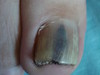 Аспергиллез ногтя. Клинические фото #1791