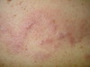 В-клеточная злокачественная лимфома кожи. №1840