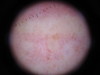 В-клеточная злокачественная лимфома кожи. №1842