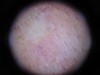 В-клеточная злокачественная лимфома кожи. №1843