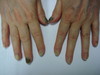 Синдром зеленых ногтей. №1862
