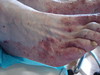 Пурпурозно-фестончатая форма дерматофитии стоп. №1873