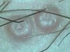 Моллюск контагиозный. Видеодерматоскопия #19