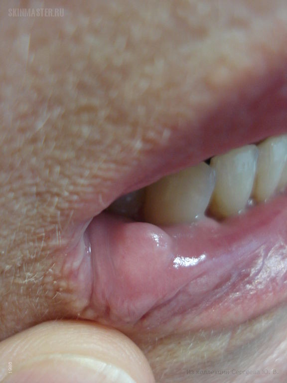 Фиброма слизистой рта