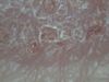Т-клеточная лимфома кожи – грибовидный микоз. №201