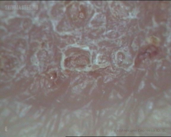 Т-клеточная лимфома кожи – грибовидный микоз