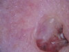 Плоскоклеточный рак кожи, язвенный тип. №2306
