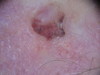 Плоскоклеточный рак кожи, язвенный тип. №2307