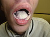Кандидоз рта и глотки. Клинические фото #2318