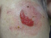 Диффузный воспалительный рак кожи. №2321
