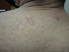 Диффузный воспалительный рак кожи. №2322