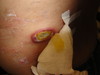 Т-клеточная лимфома кожи: «обезглавленный грибовидный микоз».. №2368