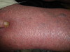 Сидром Сезари: Т-клеточная лимфома кожи. №2470