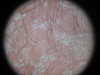 Сидром Сезари: Т-клеточная лимфома кожи. №2472