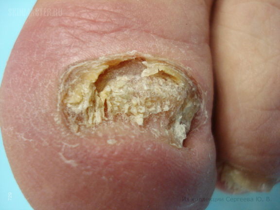 Паронихия и дерматофития ногтей