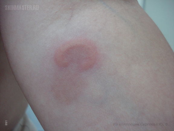    (erythema elevatum diutinum)