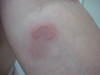    (erythema elevatum diutinum). 891