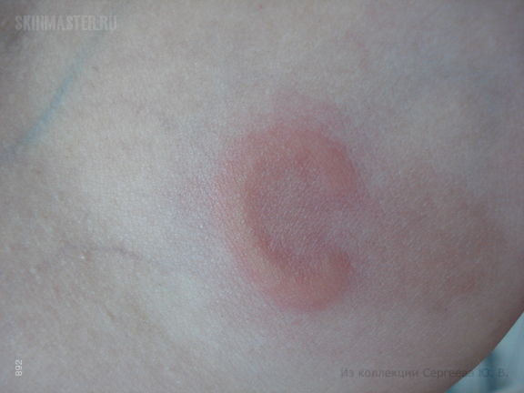    (erythema elevatum diutinum)