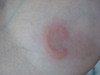    (erythema elevatum diutinum). 892