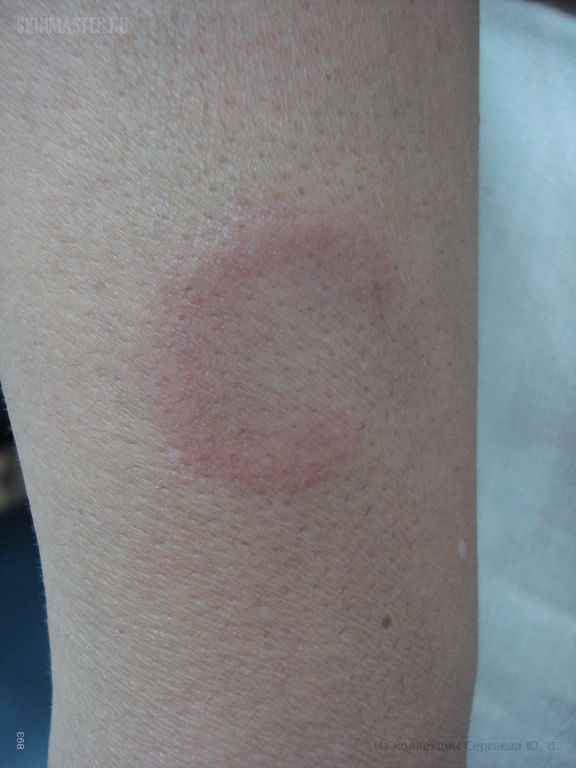    (erythema elevatum diutinum)