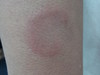    (erythema elevatum diutinum). 893