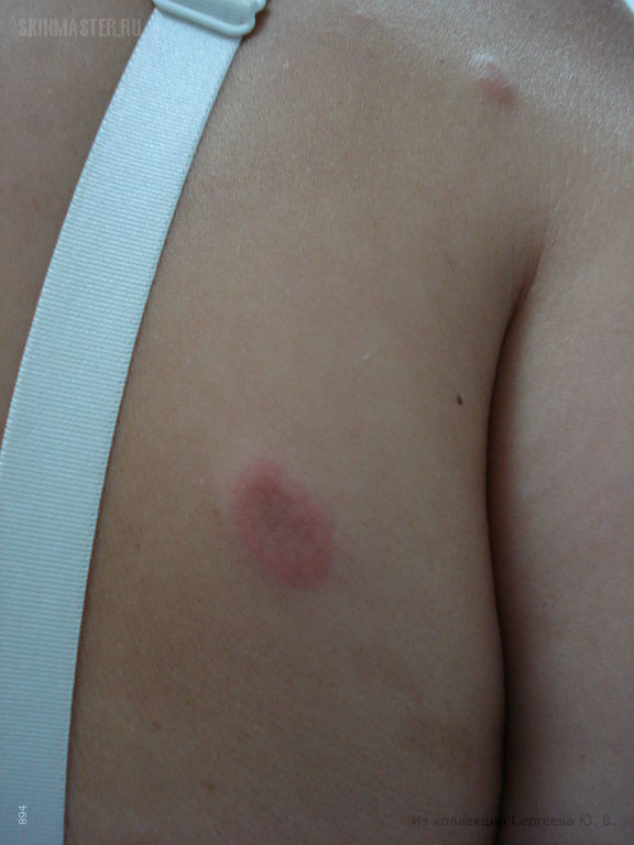    (erythema elevatum diutinum)