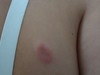    (erythema elevatum diutinum). 894