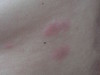    (erythema elevatum diutinum). 895