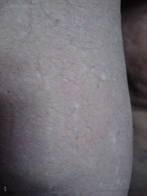   (stucco keratosis)  