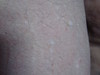   (stucco keratosis)  . 908