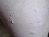   (stucco keratosis)  . 909