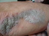   (stucco keratosis)  . 910